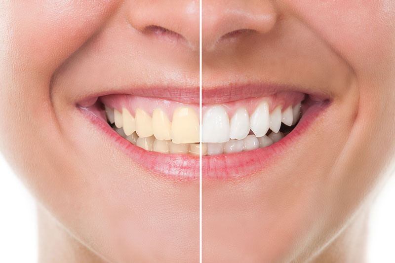 Teeth Whitening in Manhattan Beach